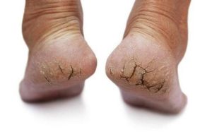 Say Goodbye to Cracked Heels: 5 Proven Home Remedies
