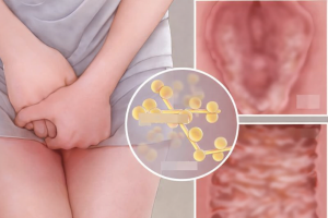 Women with Gynec.ological Infections Are Advised to Change These Common Habits