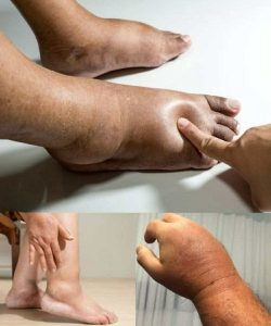 Foods that can ease swelling in hands and feet
