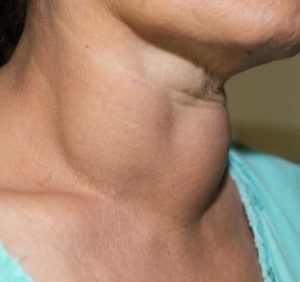 Avoid these 6 foods that may be harmful to your thyroid health.