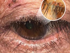 Morning Eye Itch? The Truth About Eyelash Hygiene