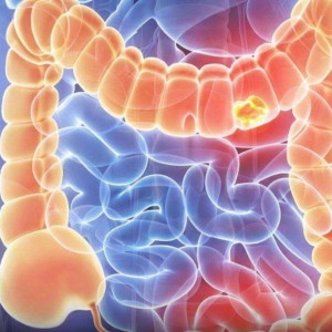 Woman Diagnosed with Stage Four Colon Cancer Warns Others: 5 Symptoms She Ignored