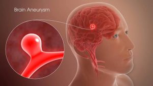 Aneurysm: Signs and Symptoms You Shouldn’t Ignore