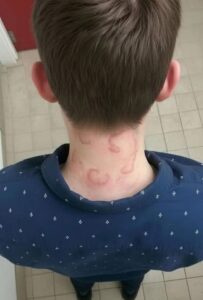 Child Skin Health: Decoding Ring-Shaped Marks On The Neck