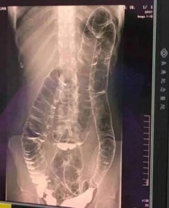 Understanding Extreme Intestinal Expansion