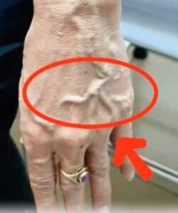 Visible Veins Explained: What Your Body Might Be Telling You