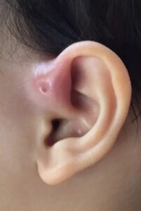 The Mystery of the Preauricular Sinus: Why Do Some People Have a Tiny Hole Near Their Ear?