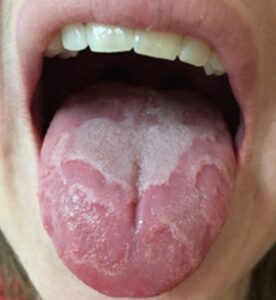 Your Tongue Health and What It Reveals About Your Body