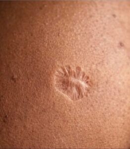 Why Does Vaccination Leave This Mark On The Skin? The Real Reason Many People Never Knew