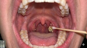 Doctors Explain The Strange White Lumps Some People Suddenly Find In Their Throat