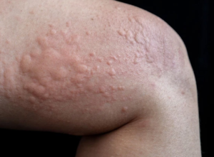Frequent Hives May Be A Warning Sign Of An Underlying Health Problem, Doctors Say