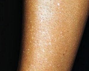 Have You Noticed Small White Spots On Your Arms Or Legs… And You Don’t Know What They Are?