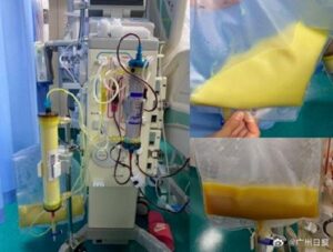 27-Year-Old Woman’s “Milk-Colored Blood” Shocks Doctors — Popular Drink Blamed As Hidden Cause