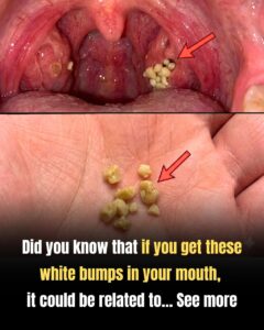 What Are Those Weird White Bumps in Your Throat?