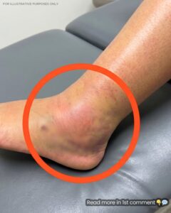 Why Older Adults Experience Swollen Legs: Causes, Warning Signs, and Simple Solutions