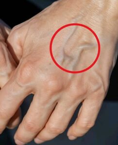 Why Are My Hand Veins Bulging? Causes, Risks, and Solutions