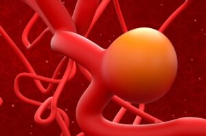 Brain Aneurysm: Warning Signs You Should Never Ignore