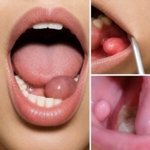 Understanding Unexpected Oral Bumps: Comprehensive Guide to Causes, Identification, and Care