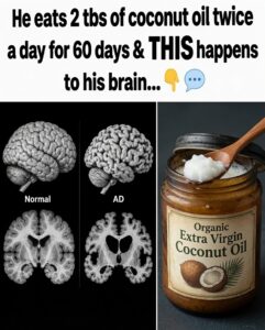 Coconut Oil and Brain Health: Separating Hype from Clinical Evidence