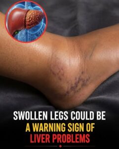 Swollen Legs: When They Could Be a Warning Sign of Liver Health Issues