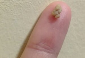 Suddenly It Feels Like Something Is Stuck in Your Throat… Then a Small White Lump Pops Out. What Is It?