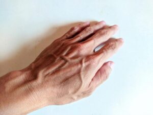 Visible Hand Veins: A Normal Sign or a Warning? Here’s What Doctors Want You to Know