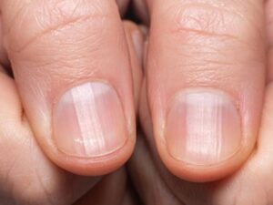 Nail Lines After 40: What They May Mean for Your Health